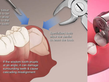 dental-extraction