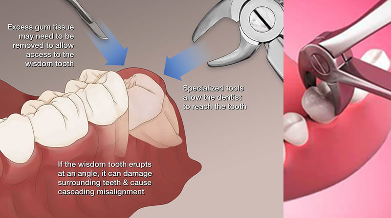 dental-extraction