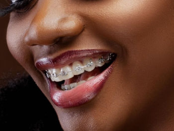 Braces Kenya