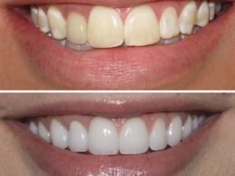 Teeth Whitening Nairobi