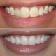 Teeth Whitening Nairobi