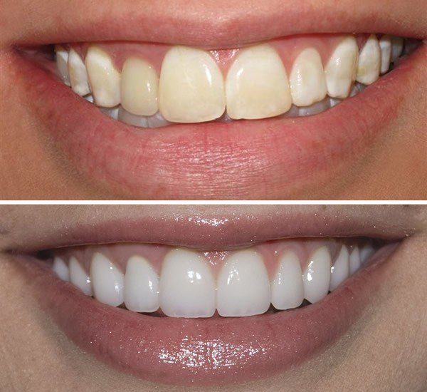 Teeth Whitening Nairobi